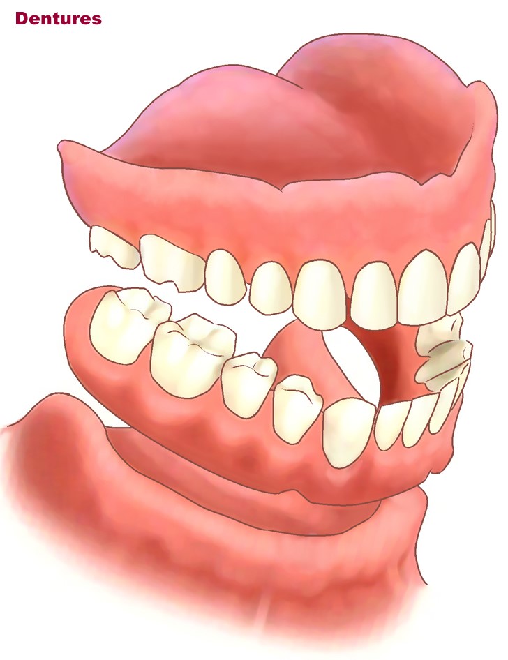 Upper Dentures Without Palate Miami FL 33199